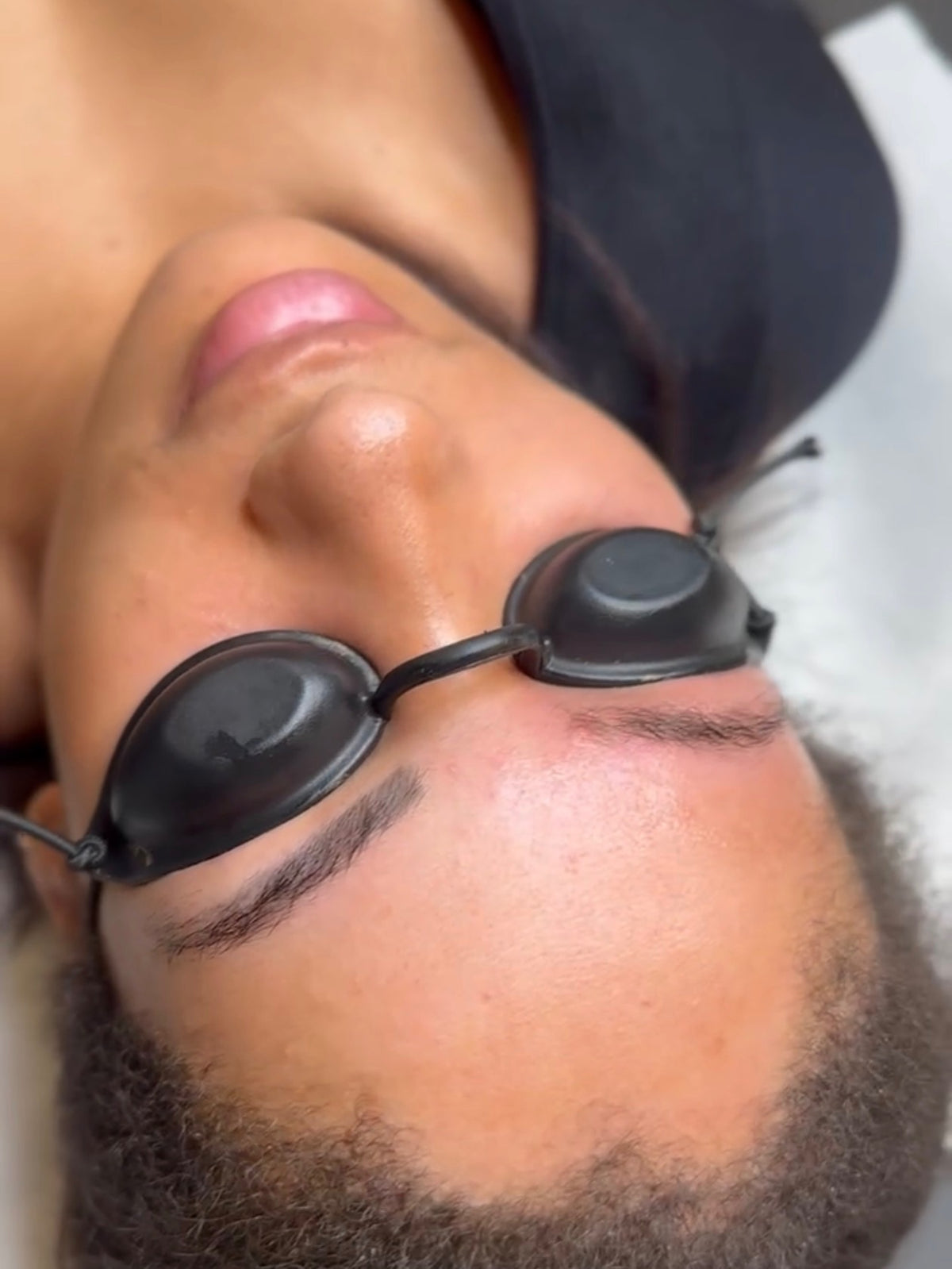 Eyebrow Tattoo Laser Removal