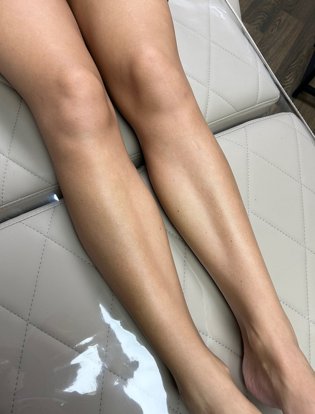 Full Leg Laser Hair Removal