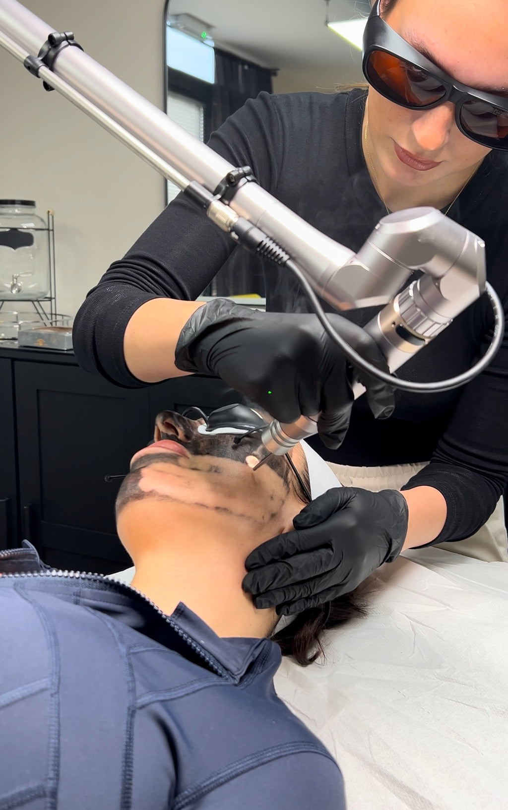 Carbon Laser Facial