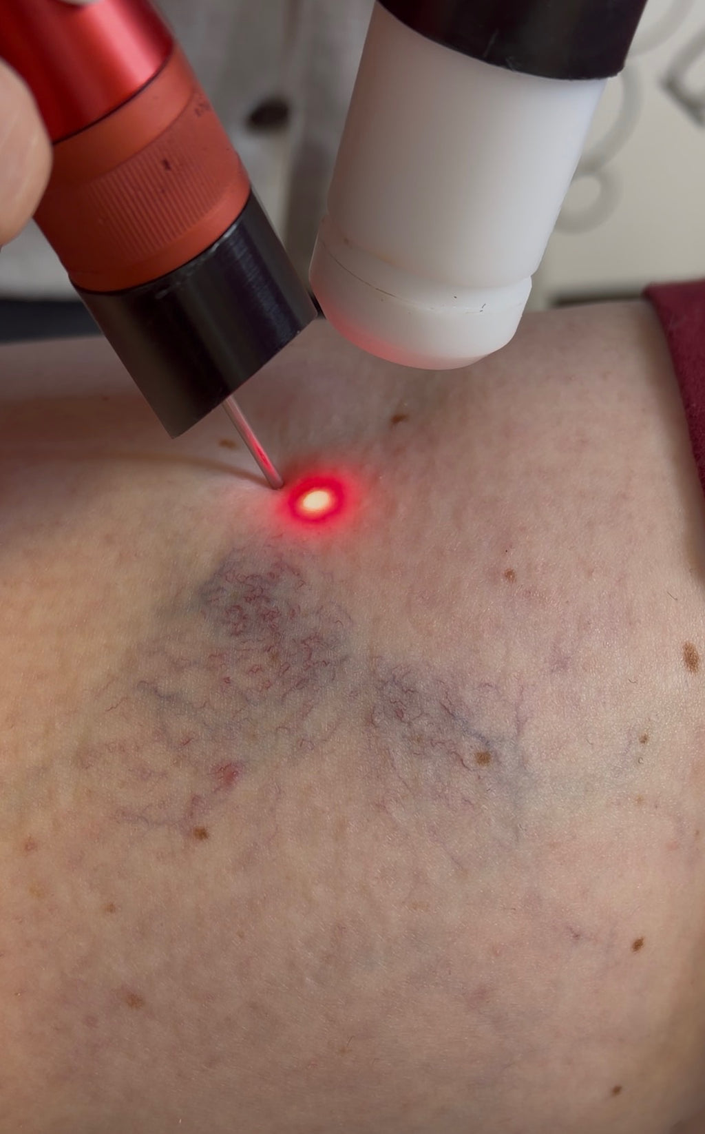 Thread & Spider Vein Laser Removal