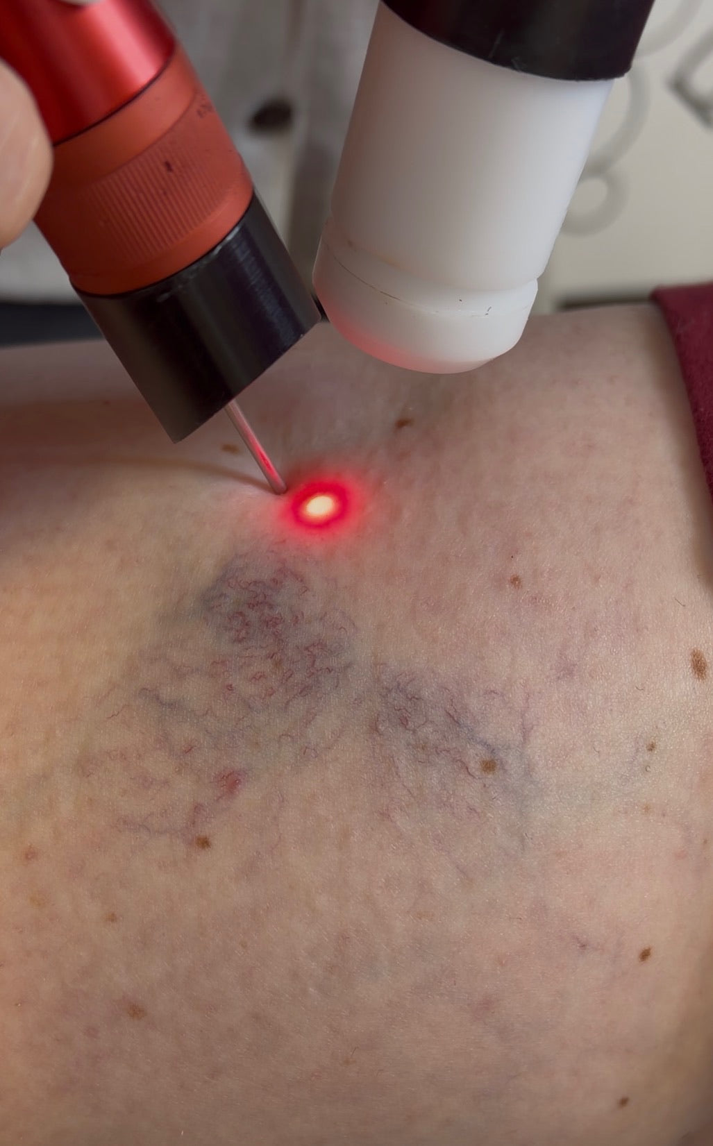 Thread & Spider Vein Laser Removal