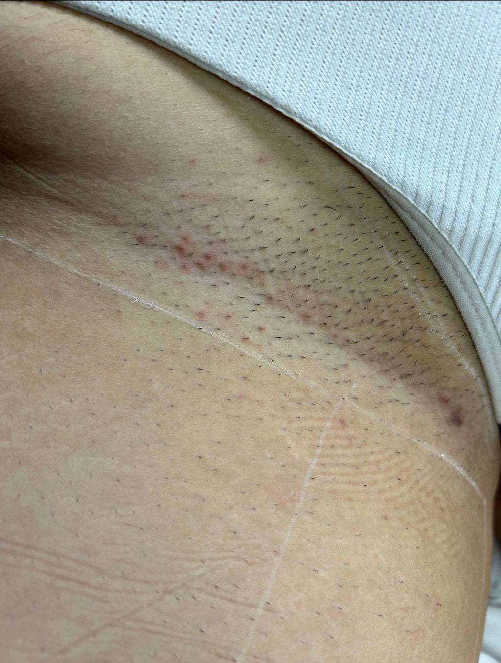 Hollywood Including Perianal Laser Removal