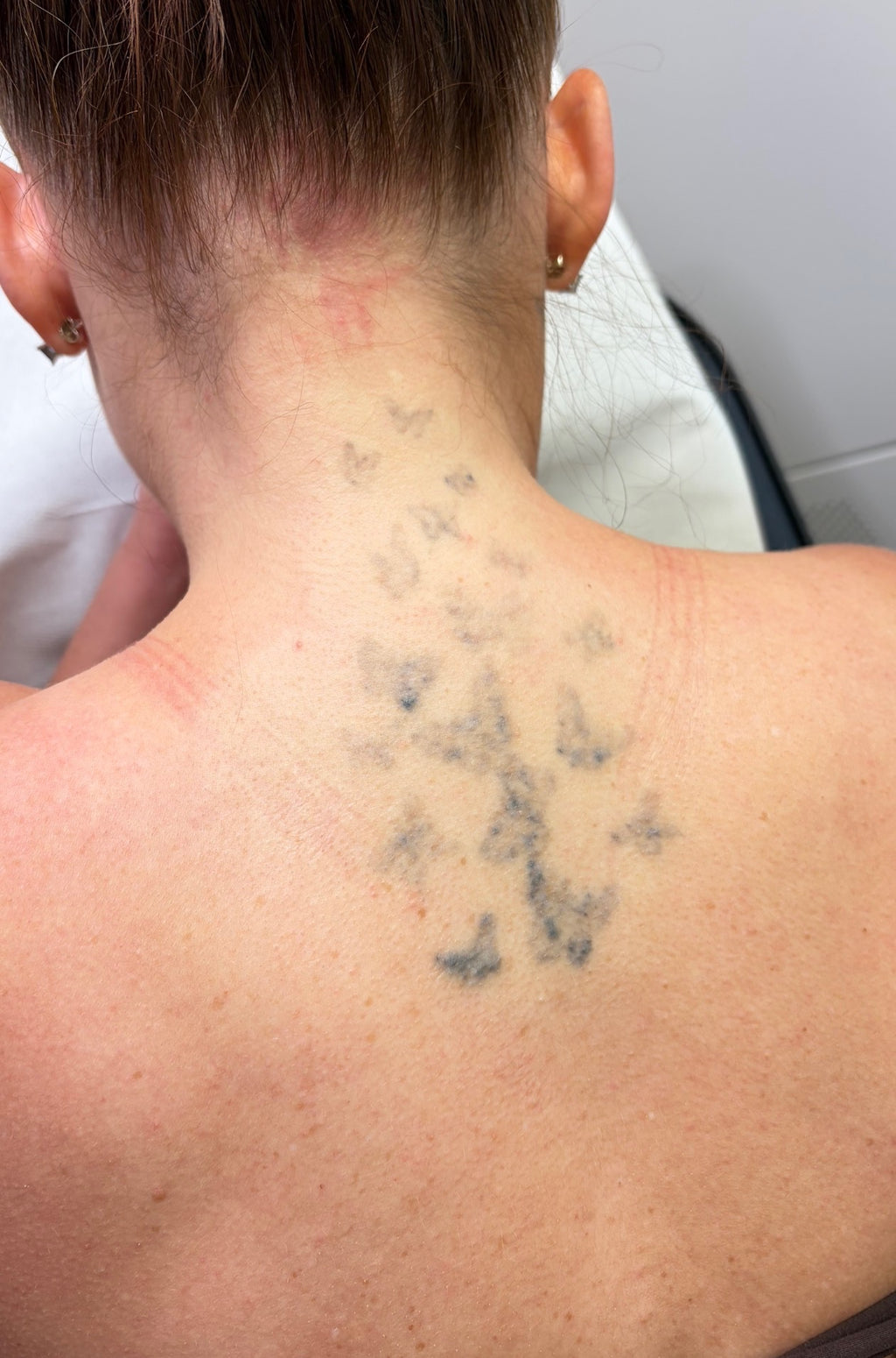 Hand, Neck & Face Laser Tattoo Removal