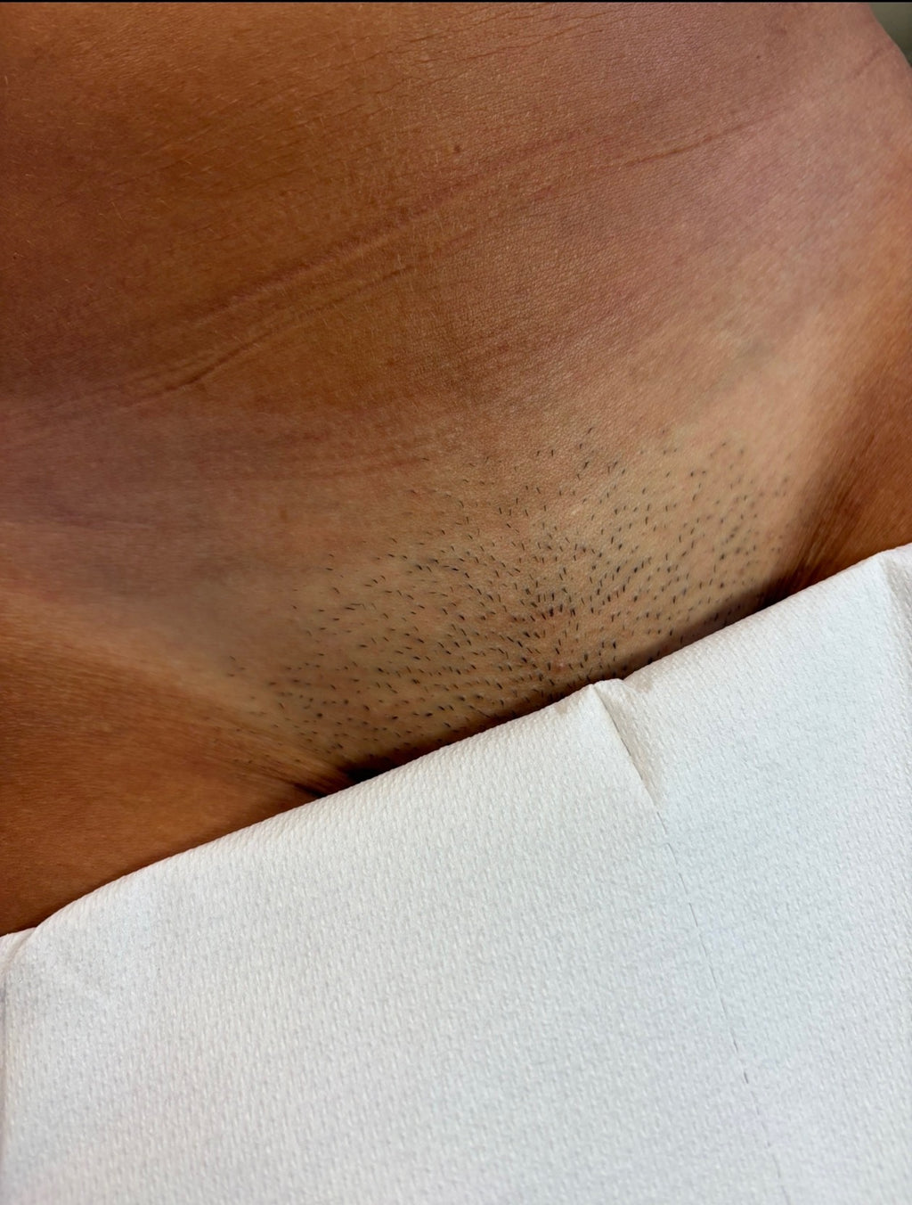 Hollywood Including Perianal Laser Removal