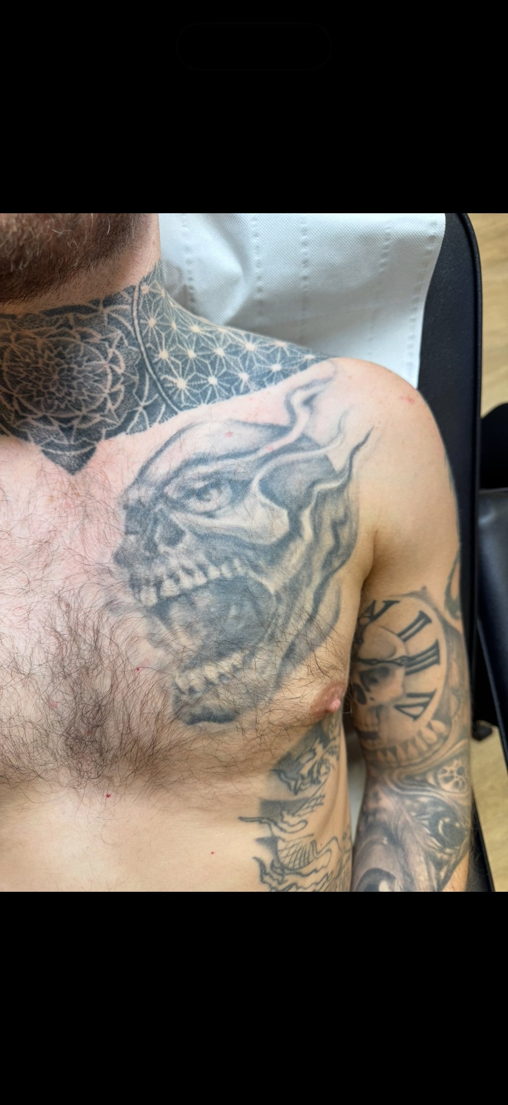 Body Laser Tattoo Removal