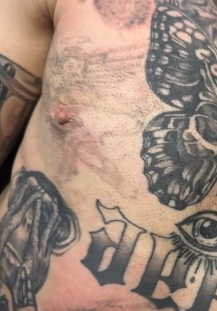 Laser Tattoo Fading for Cover-Ups