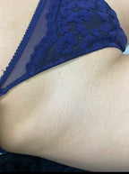 Hollywood Including Perianal Laser Removal