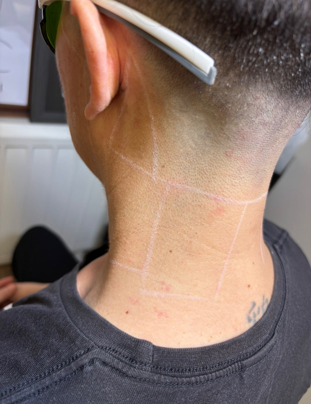 Neck Shaping Laser Hair Removal