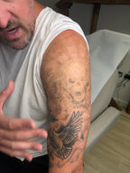 Body Laser Tattoo Removal