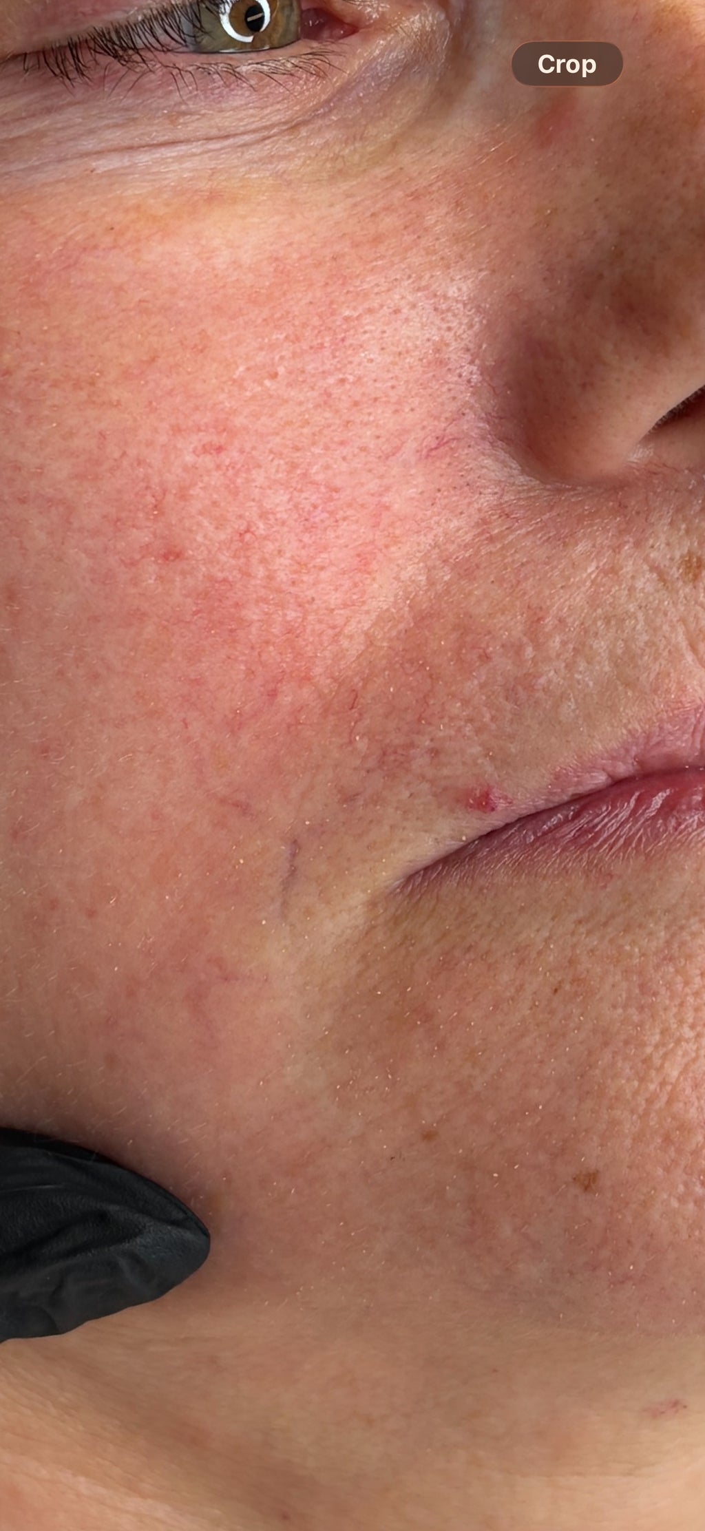 Thread & Spider Vein Laser Removal