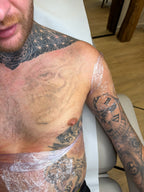 Body Laser Tattoo Removal