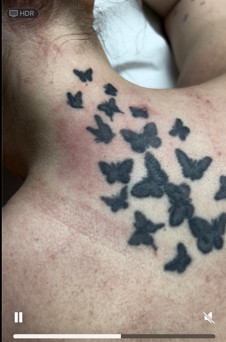 Hand, Neck & Face Laser Tattoo Removal