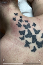 Hand, Neck & Face Laser Tattoo Removal