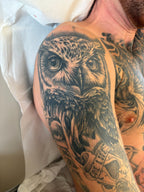 Body Laser Tattoo Removal