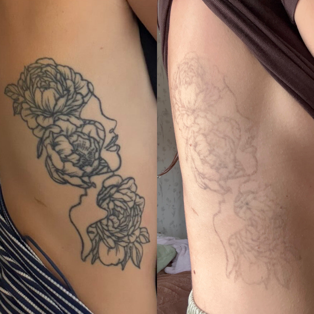 Body Laser Tattoo Removal