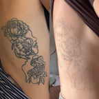 Body Laser Tattoo Removal