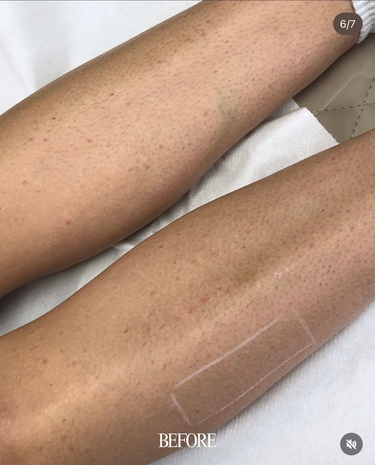 ¾ Leg Laser Hair Removal