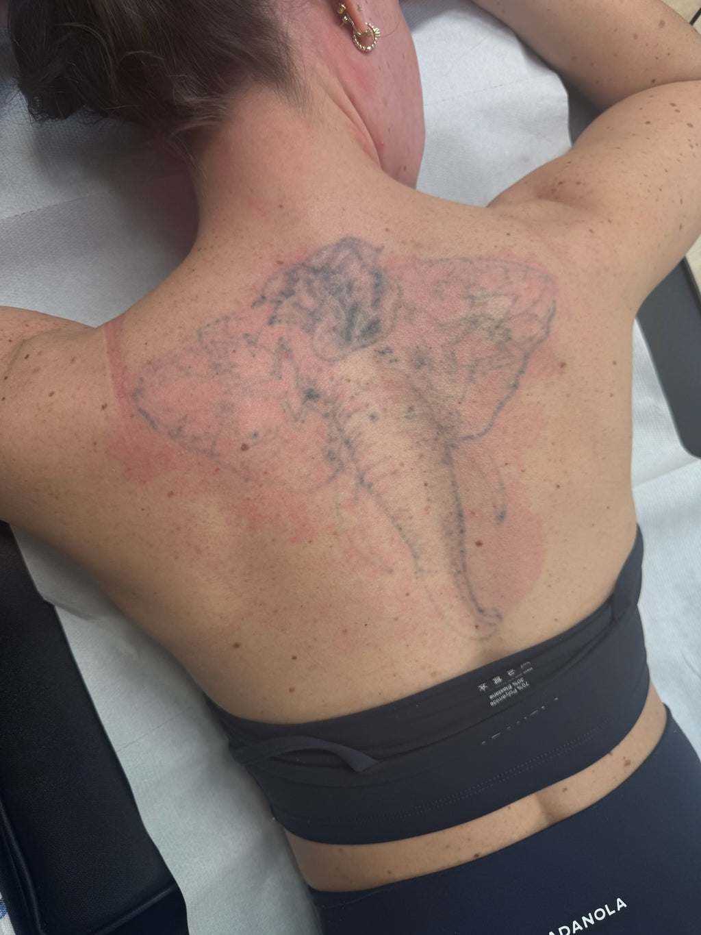 Body Laser Tattoo Removal