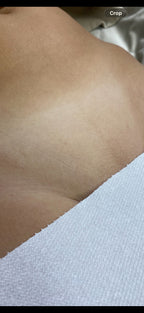 Hollywood Including Perianal Laser Removal