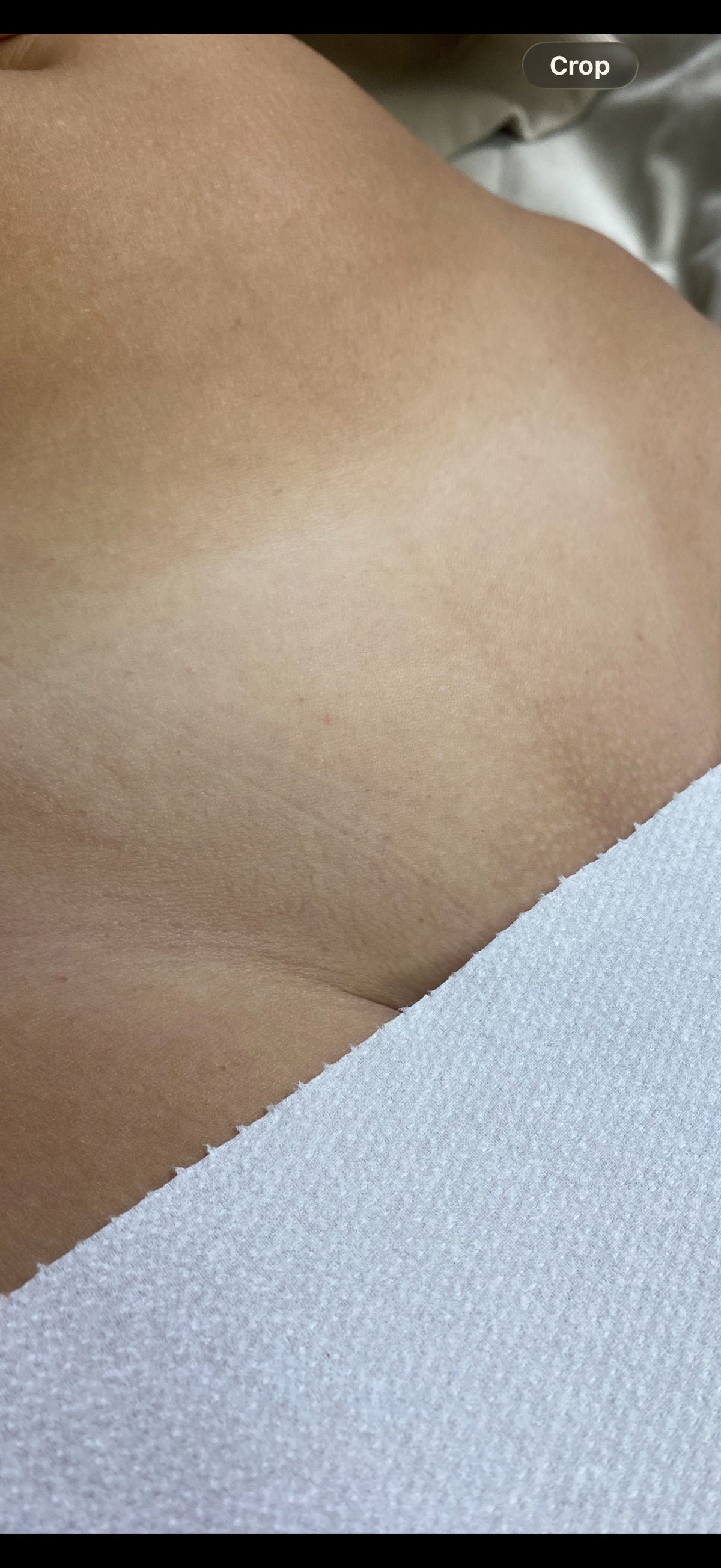 Hollywood Including Perianal Laser Removal