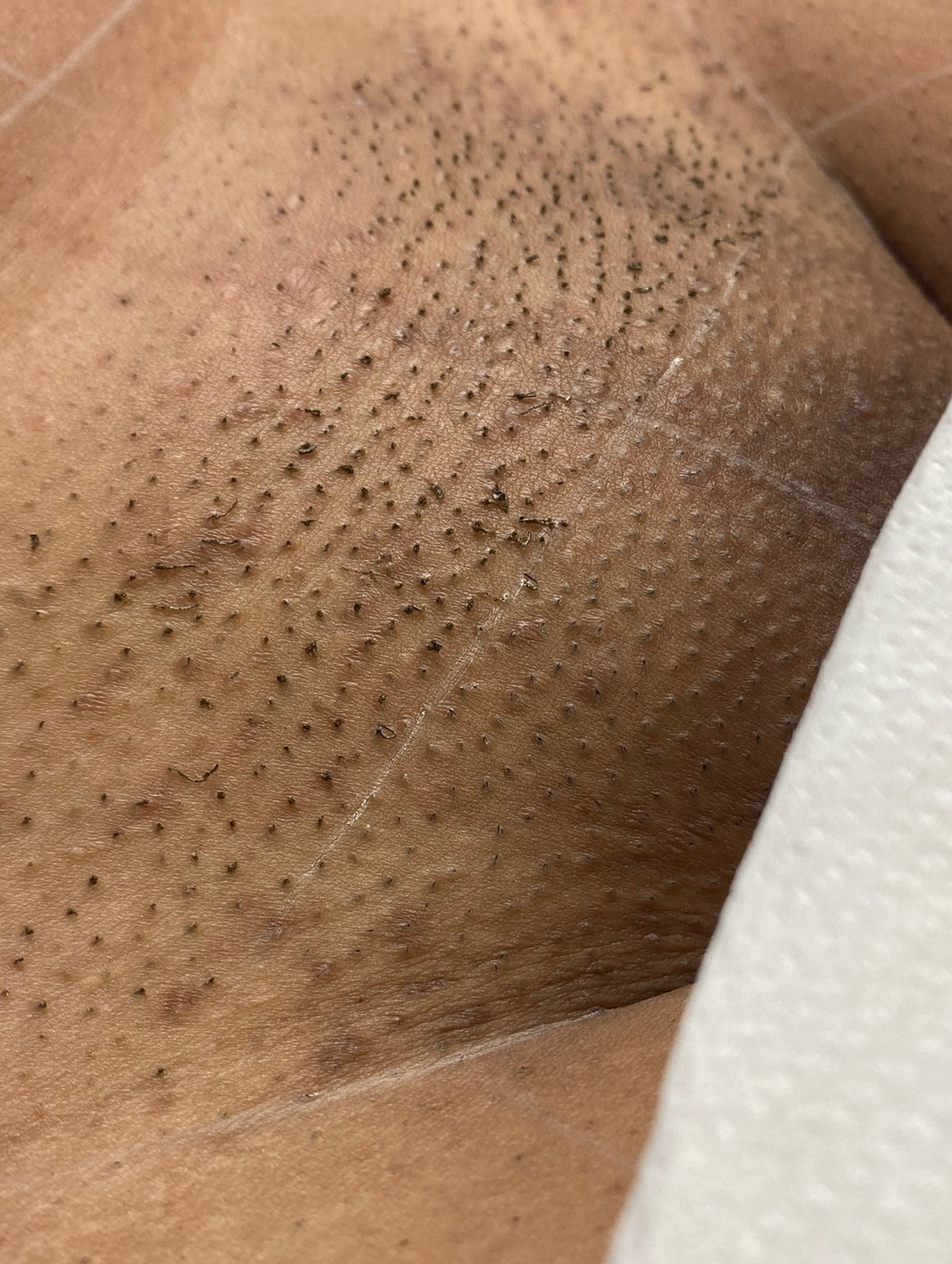 Hollywood Including Perianal Laser Removal