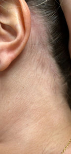 Neck Shaping Laser Hair Removal