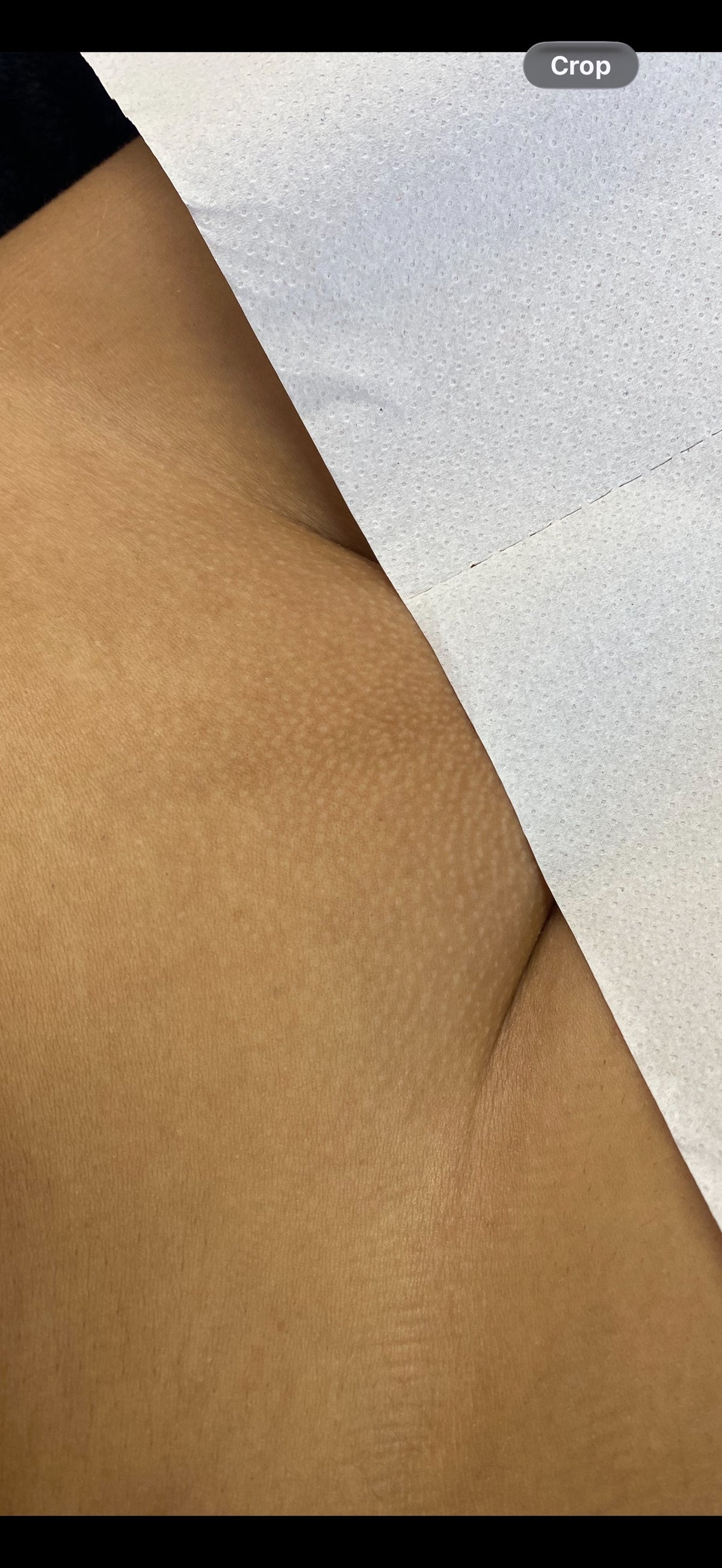 Hollywood Including Perianal Laser Removal