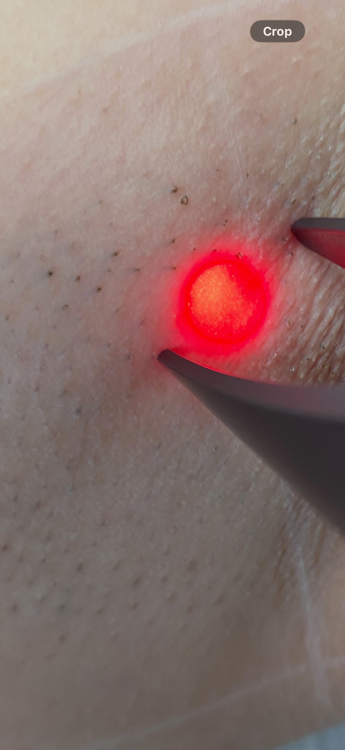 Perianal Laser Hair Removal