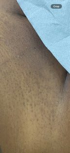 Hollywood Including Perianal Laser Removal