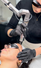 Carbon Laser Facial