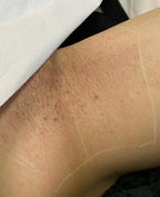 Inner Thigh Laser Hair Removal