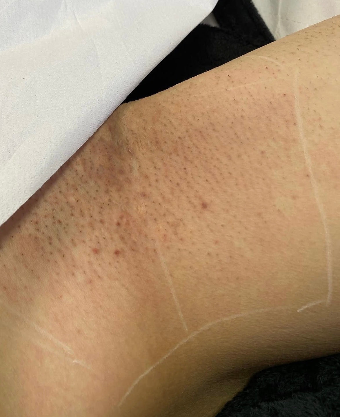 Inner Thigh Laser Hair Removal