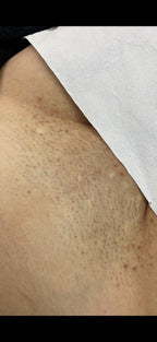 Hollywood Including Perianal Laser Removal