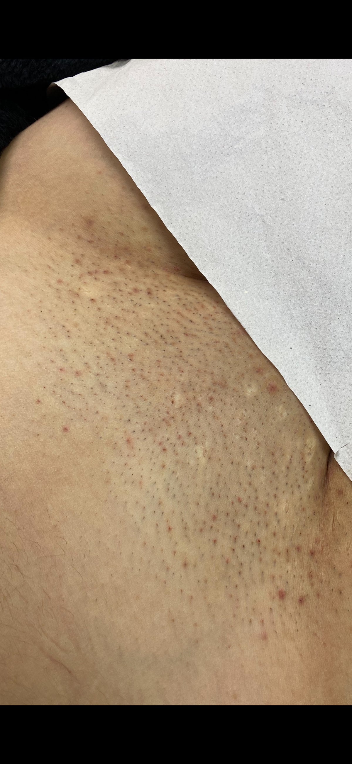 Hollywood Including Perianal Laser Removal
