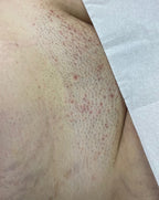 Hollywood Including Perianal Laser Removal