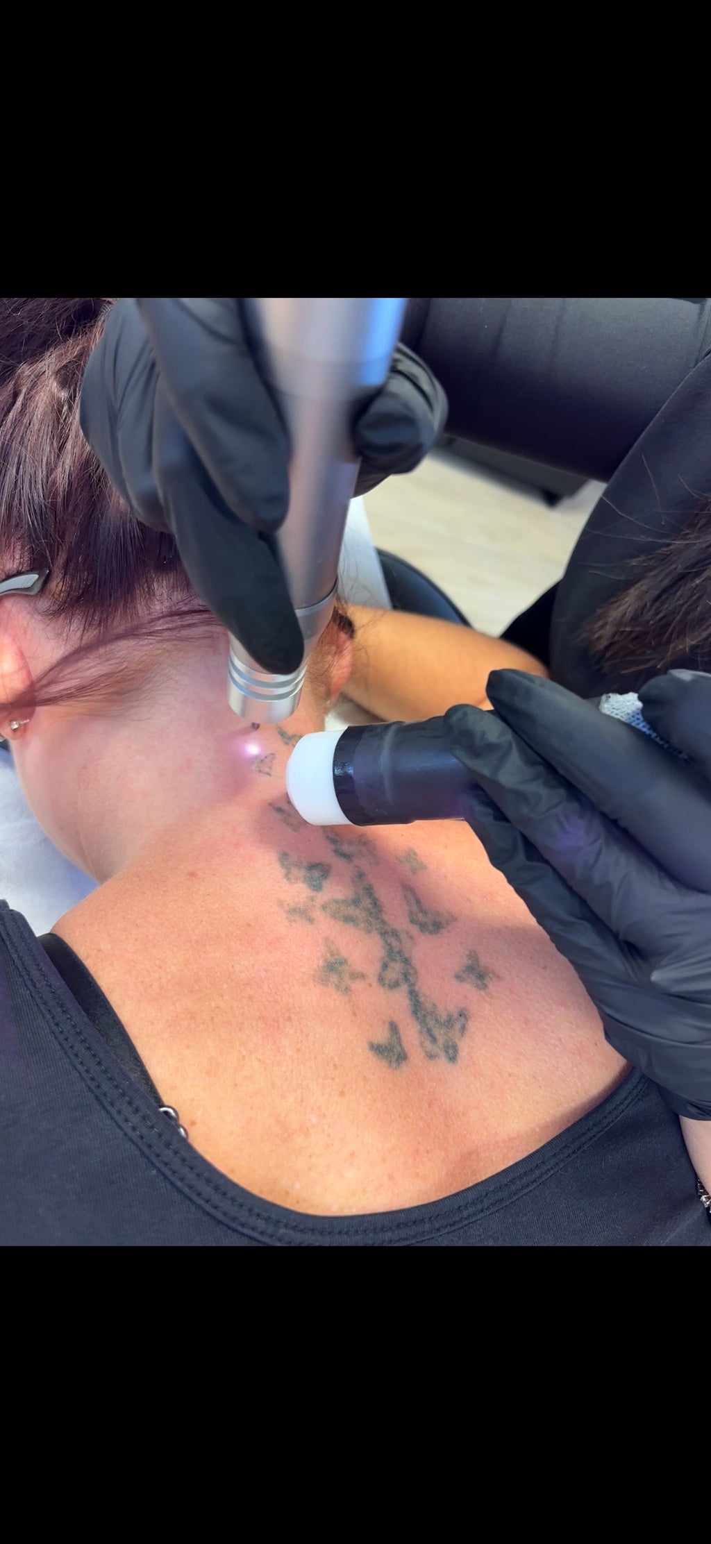 Hand, Neck & Face Laser Tattoo Removal