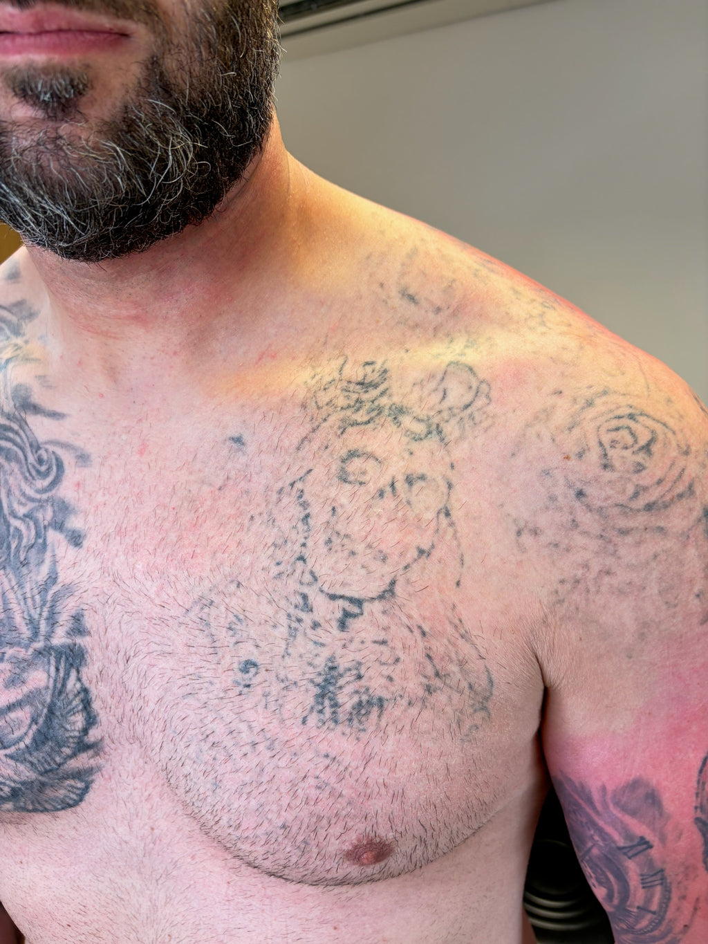 Body Laser Tattoo Removal