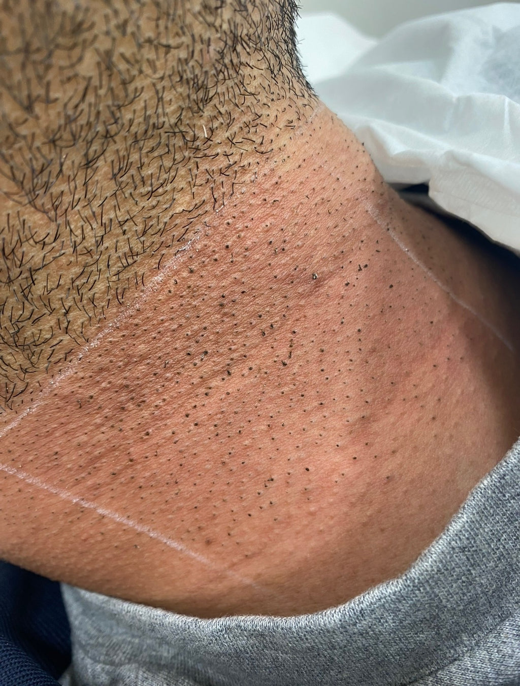 Neck Shaping Laser Hair Removal