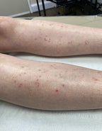 Full Leg Laser Hair Removal