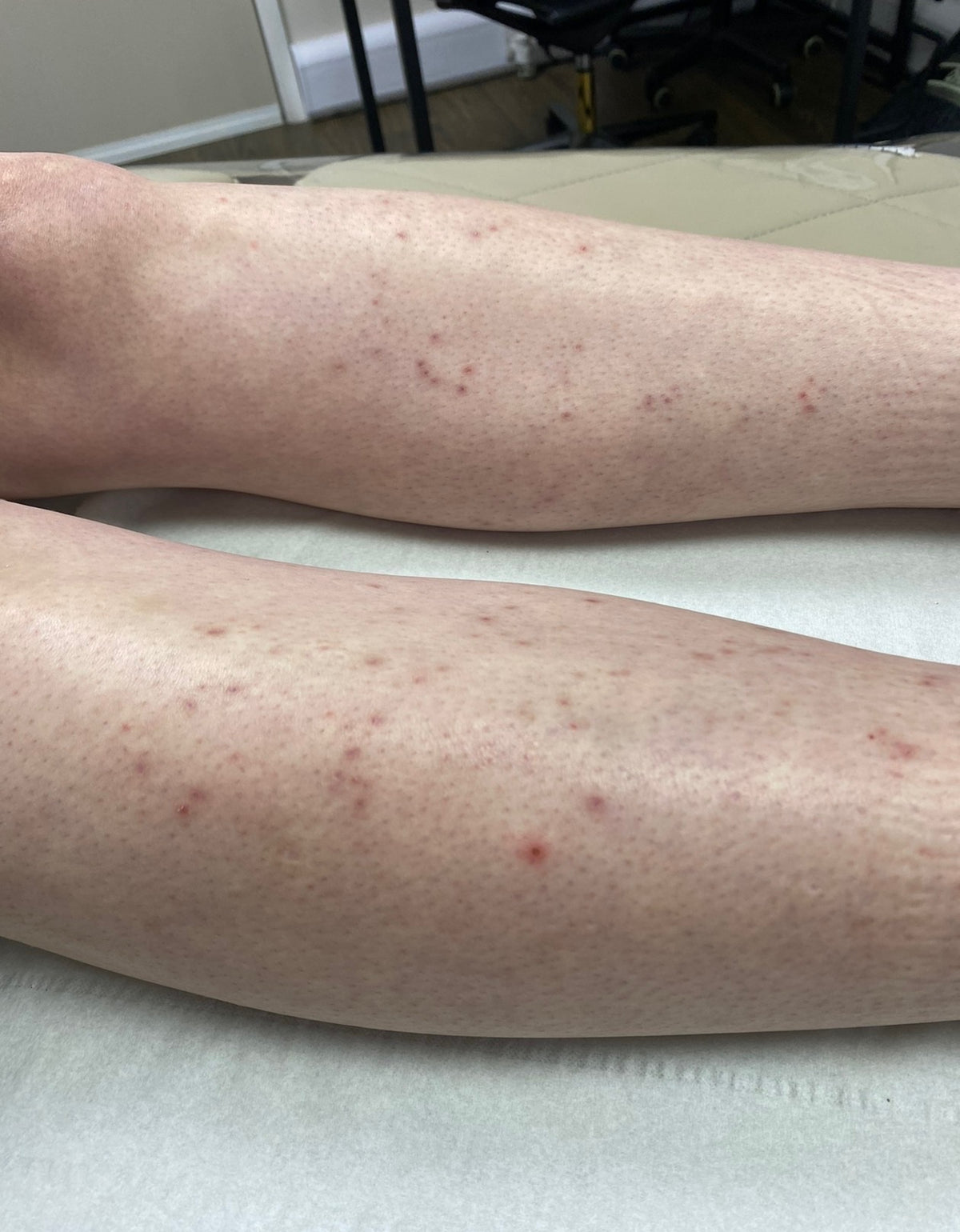 Full Leg Laser Hair Removal