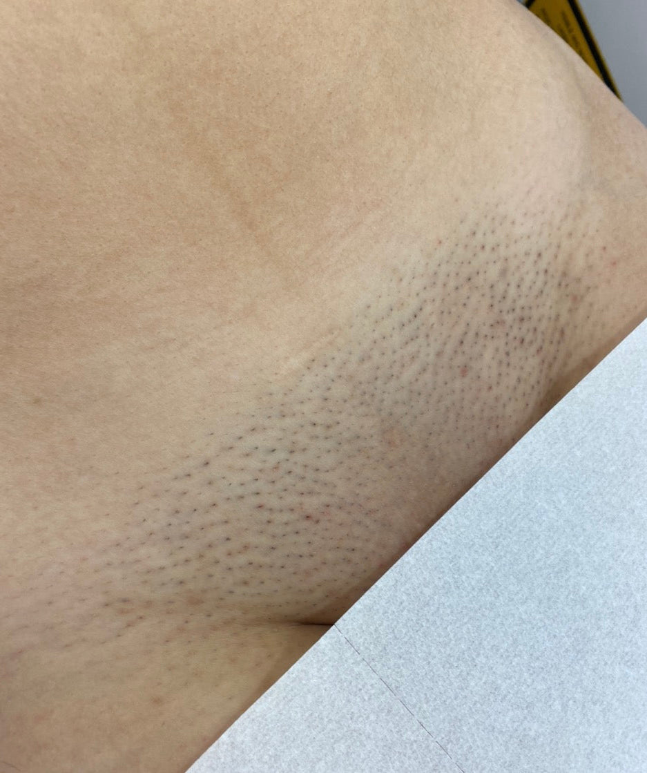Brazilian Laser Hair Removal