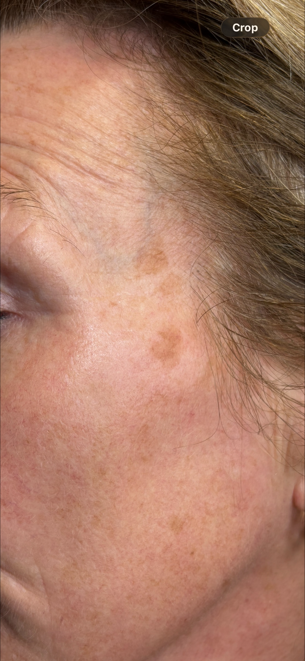 Laser Pigmentation Removal