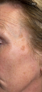 Laser Pigmentation Removal