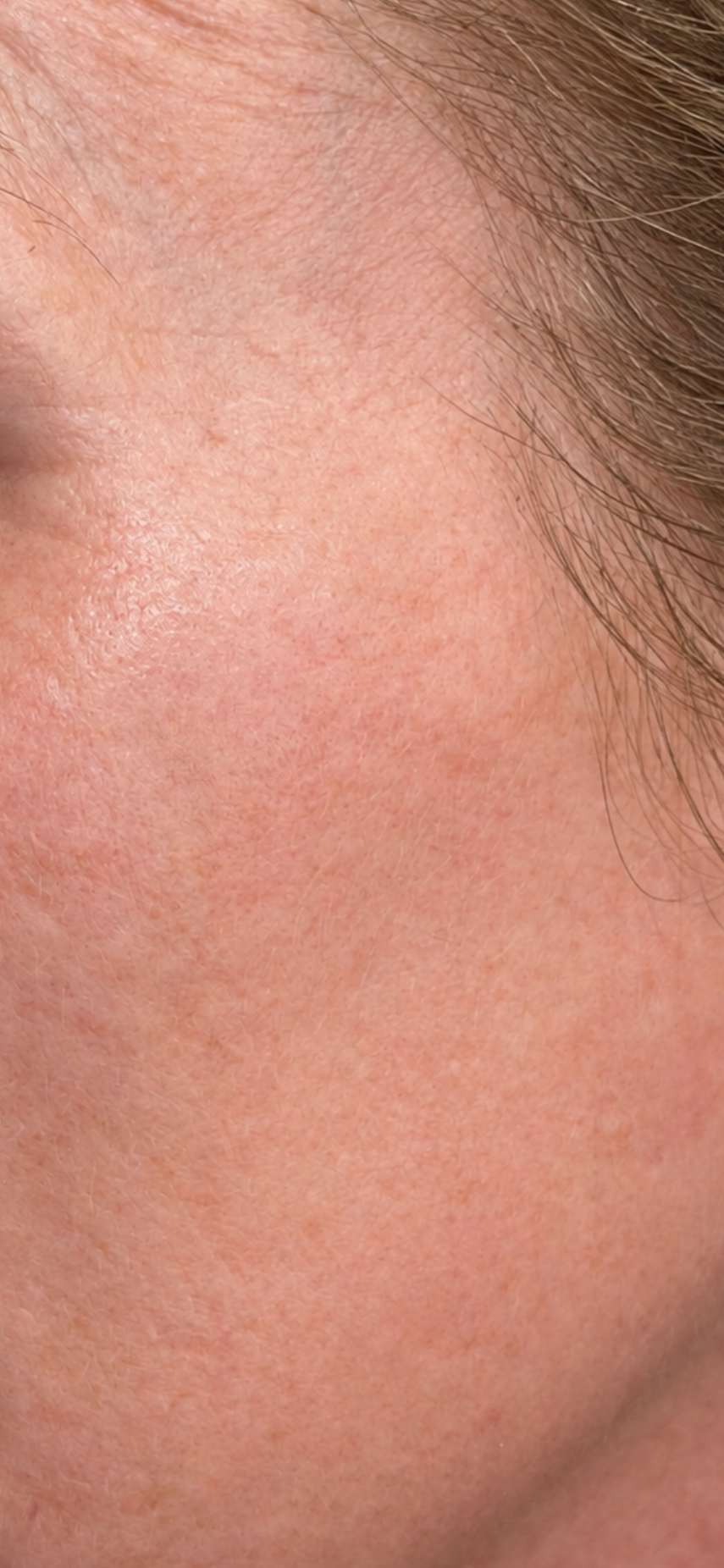 Laser Pigmentation Removal