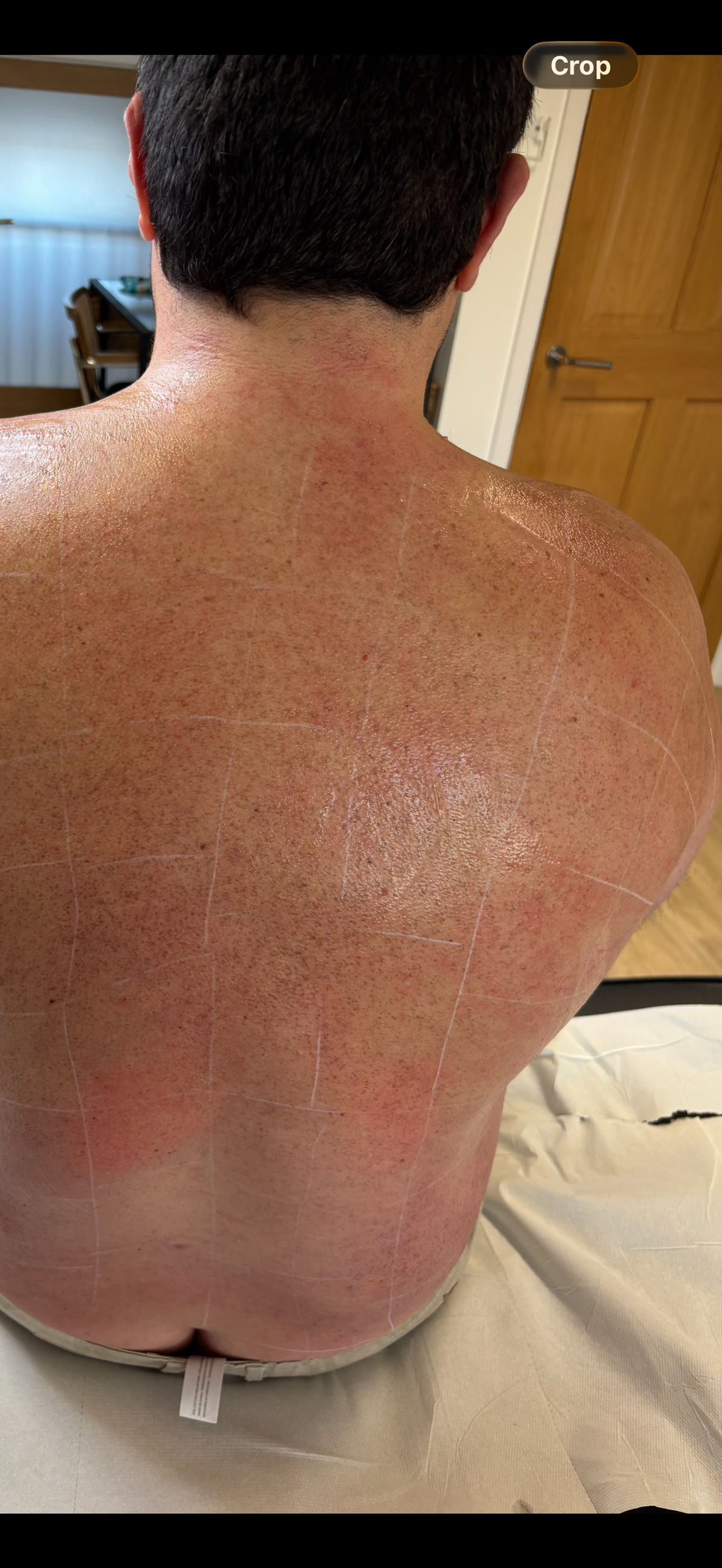 Full Back Laser Hair Removal