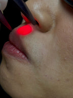 Upper Lip Laser Hair Removal