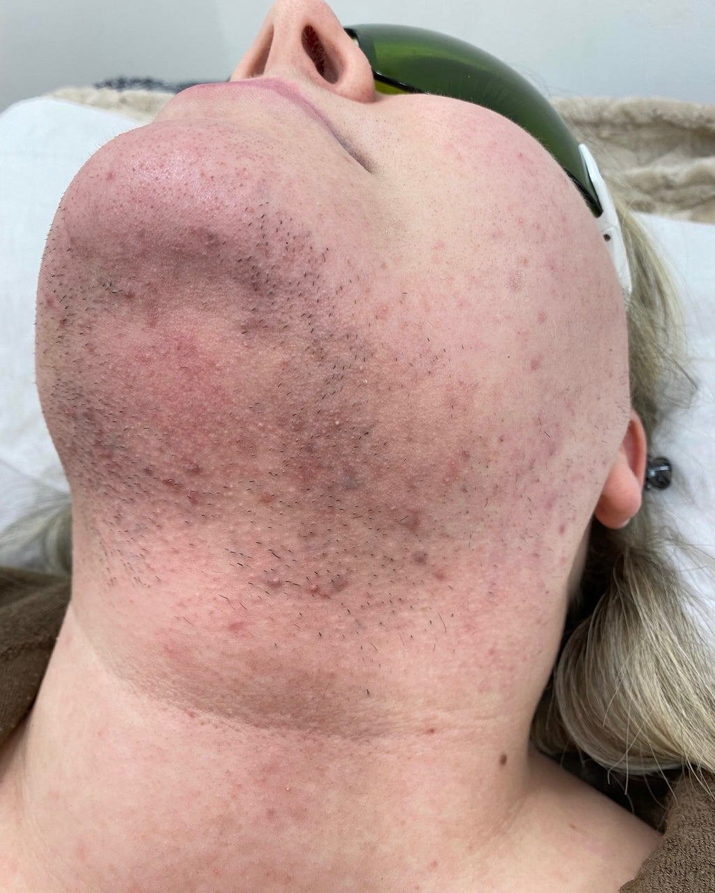 Lower Face Laser Hair Removal