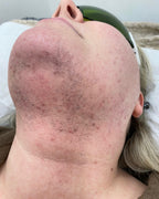 Lower Face Laser Hair Removal