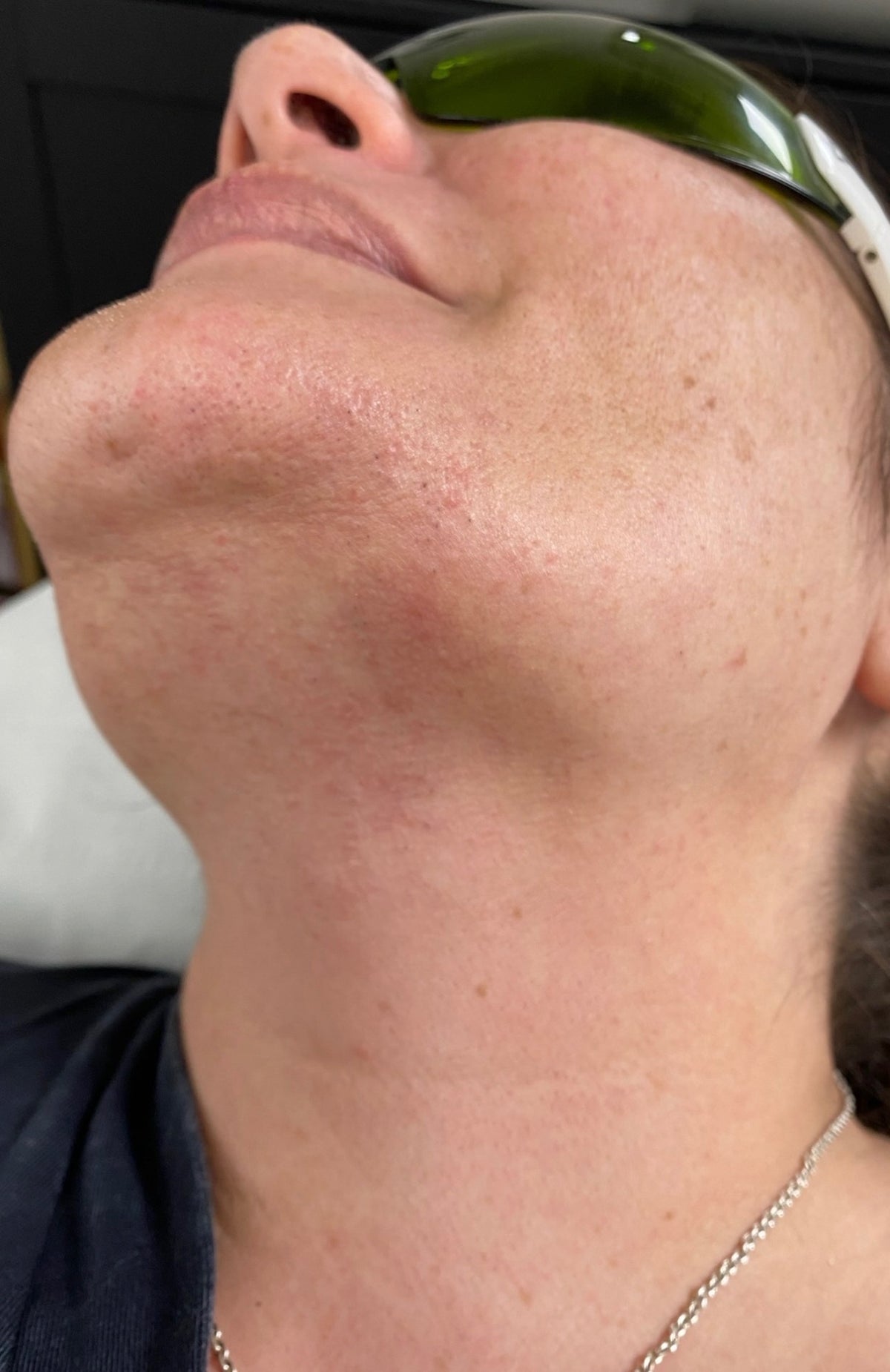 Lower Face Laser Hair Removal