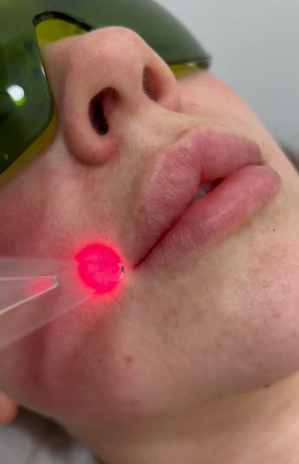Upper Lip Laser Hair Removal